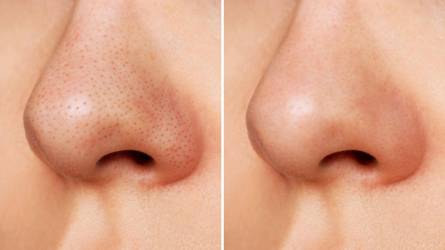 Clear Your Skin in 7 Days — Without Expensive Treatments or Harsh Chemicals