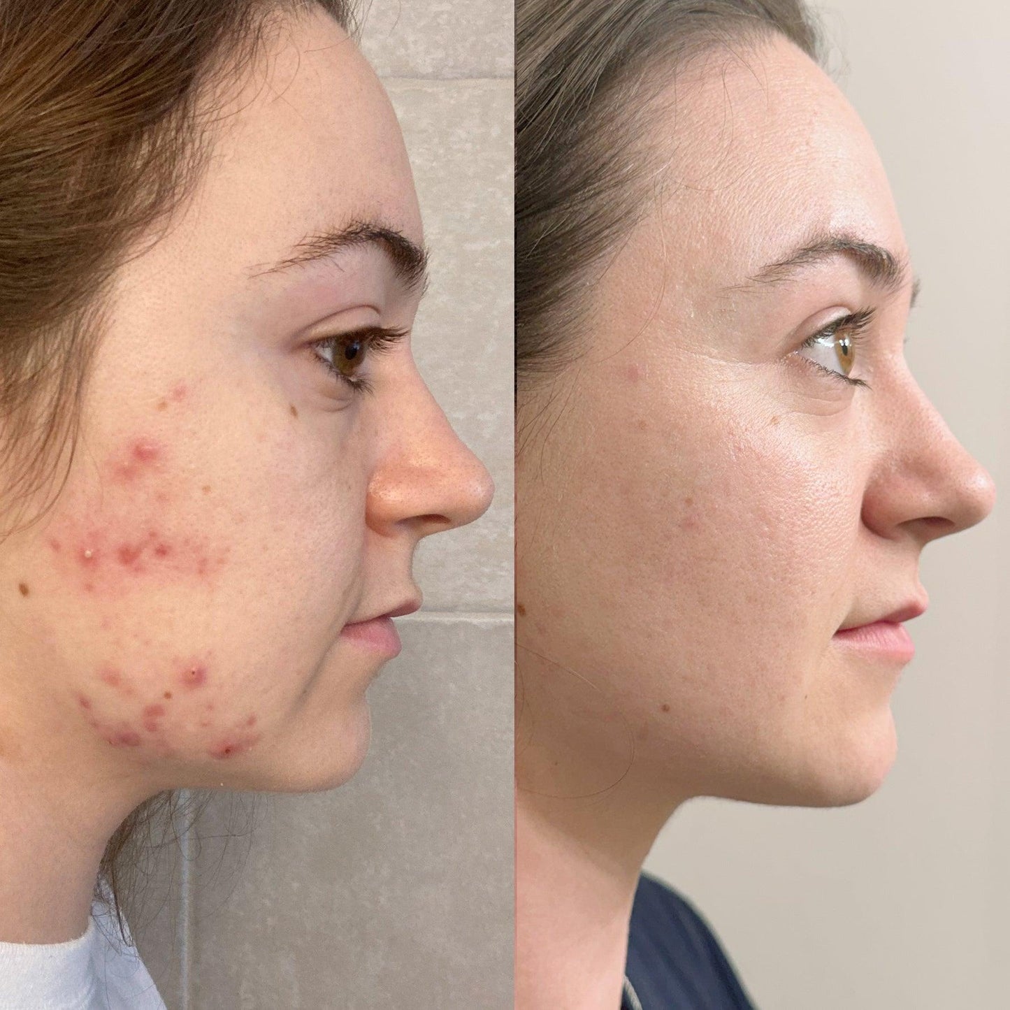Clear Your Skin in 7 Days — Without Expensive Treatments or Harsh Chemicals