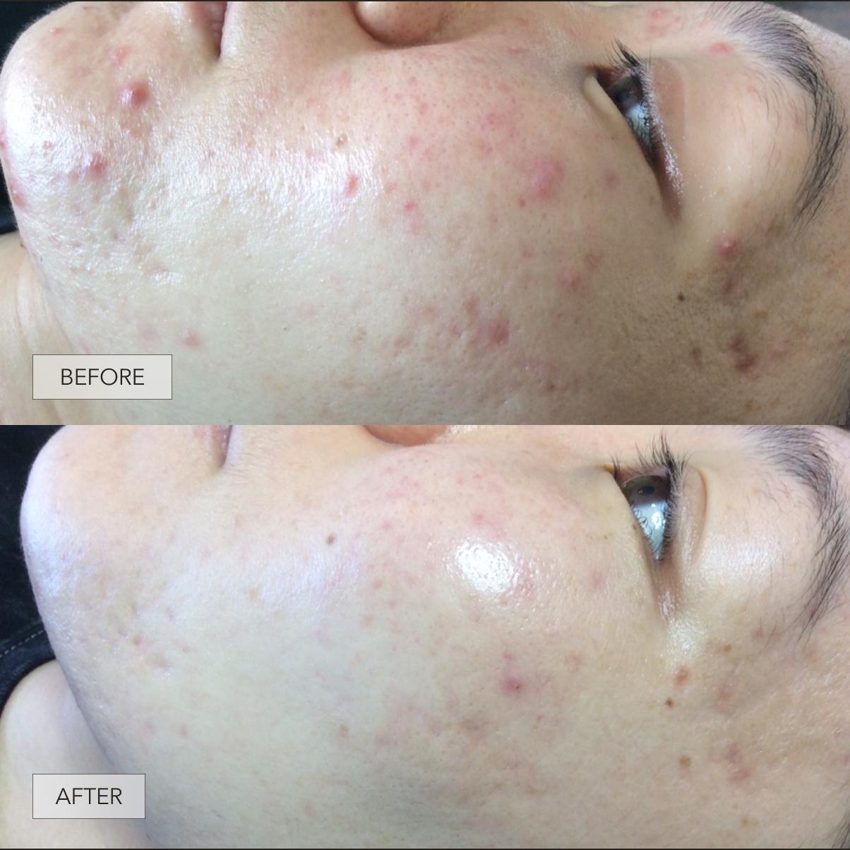 Clear Your Skin in 7 Days — Without Expensive Treatments or Harsh Chemicals