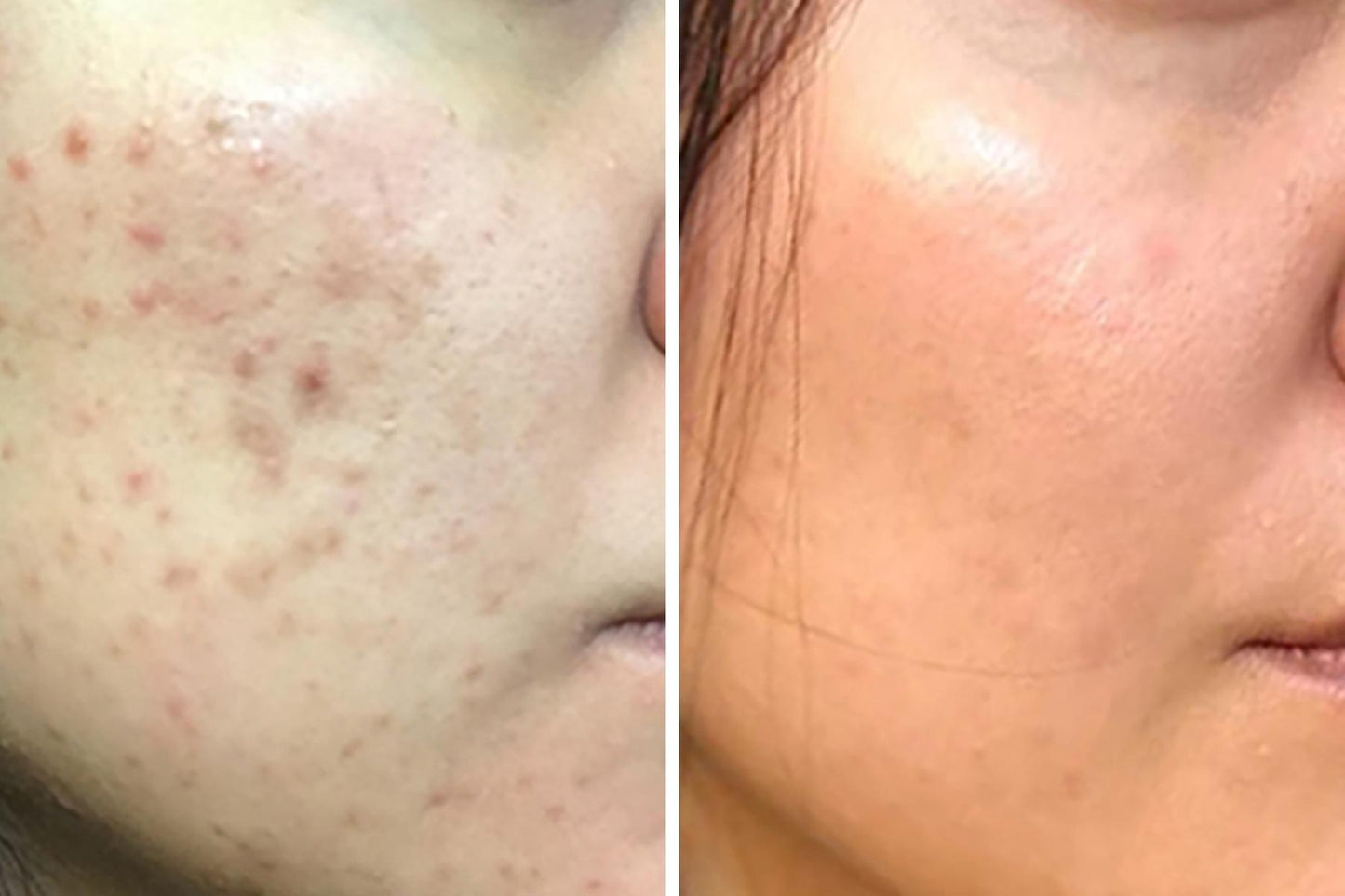 Clear Your Skin in 7 Days — Without Expensive Treatments or Harsh Chemicals